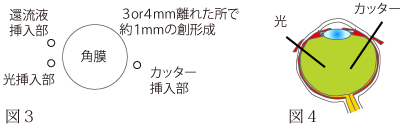 硝子体手術について　図1