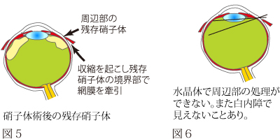 硝子体手術について　図2