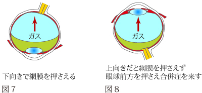 硝子体手術について　図3