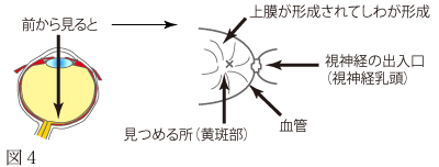 黄斑部網膜上膜形成症について　図1