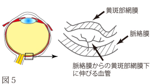 加齢性黄斑変性について　図2