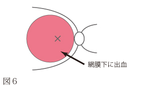 加齢性黄斑変性について　図3
