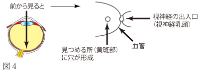高度近視による黄斑円孔網膜剥離について　図1