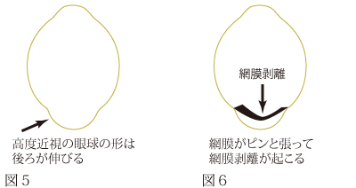 高度近視による黄斑円孔網膜剥離について　図2