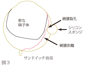網膜剥離について　図1