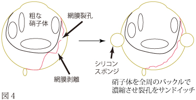 網膜剥離について　図2