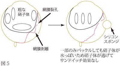 網膜剥離について　図3