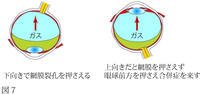 網膜剥離について　図5