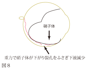 網膜剥離について　図6