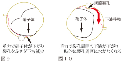 網膜剥離について　図7
